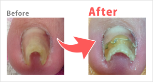 巻き爪Before after
