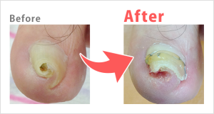 巻き爪Before after