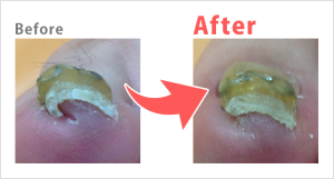 巻き爪Before after
