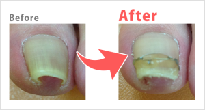 巻き爪Before after