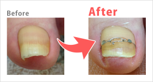 巻き爪Before after