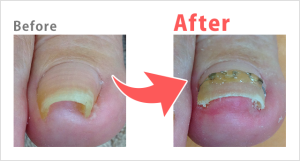 巻き爪Before after