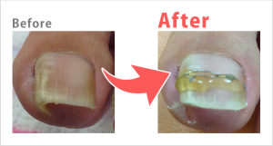 巻き爪Before after
